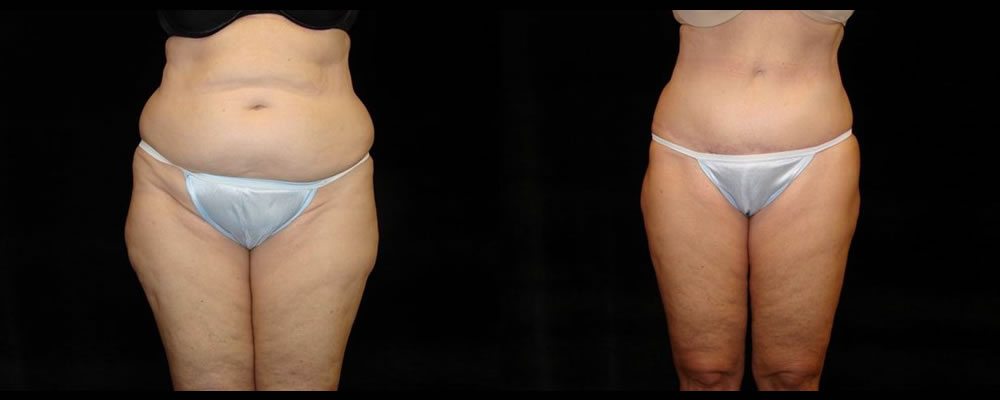 Tummy Tuck Before & After Patient #527