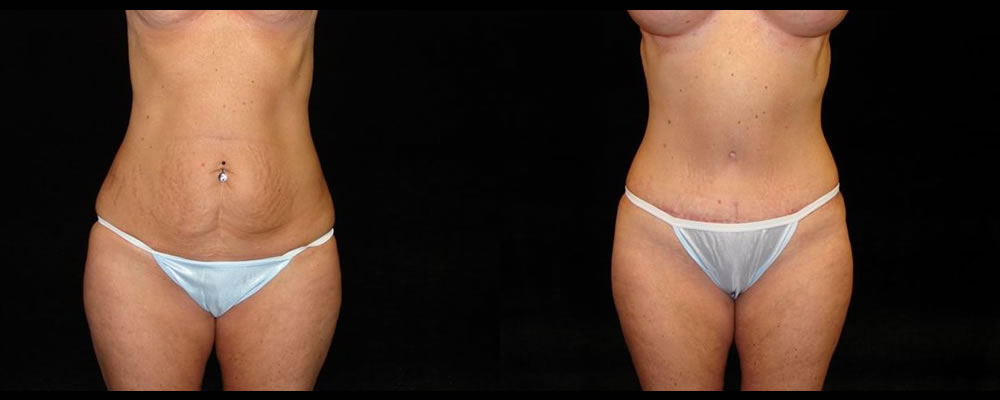 Tummy Tuck Before & After Patient #523