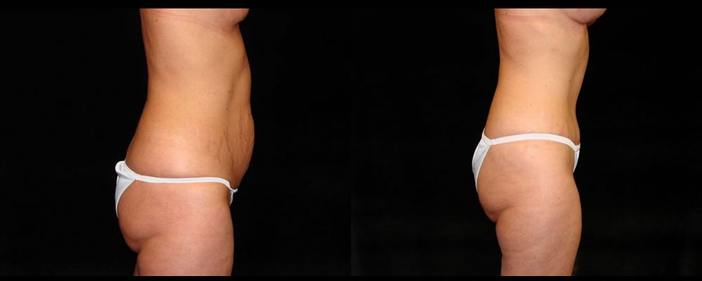 Tummy Tuck Before & After Patient #523