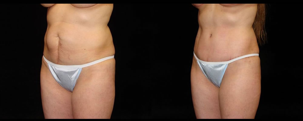 Tummy Tuck Before & After Patient #519