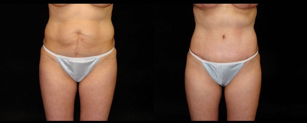 Tummy Tuck Before & After Patient #519