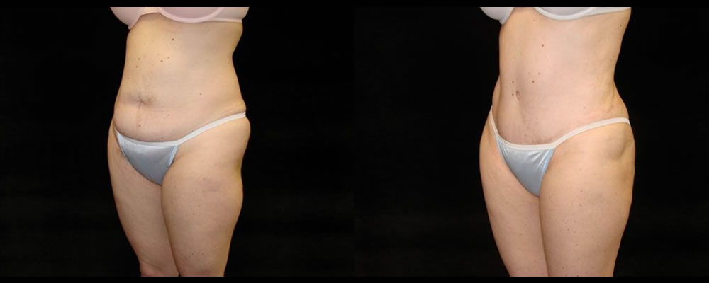 Tummy Tuck Before & After Patient #515