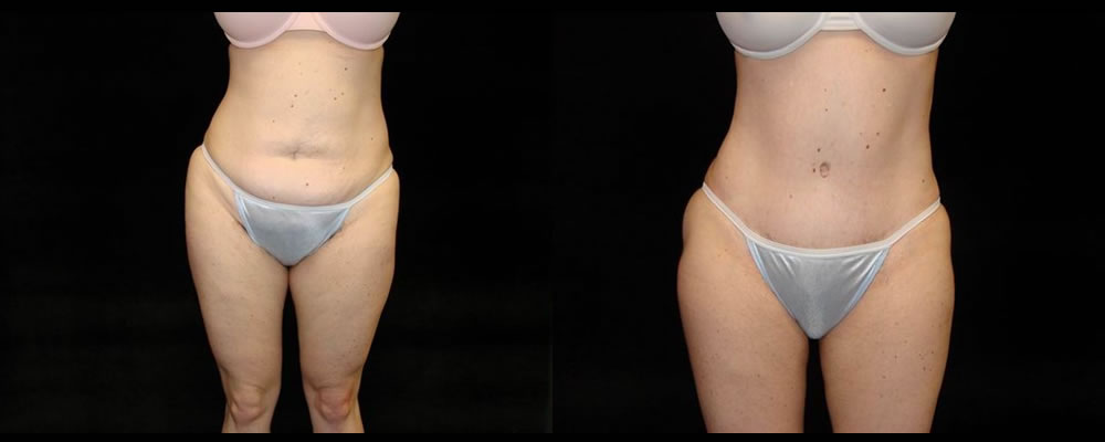Tummy Tuck Before & After Patient #515