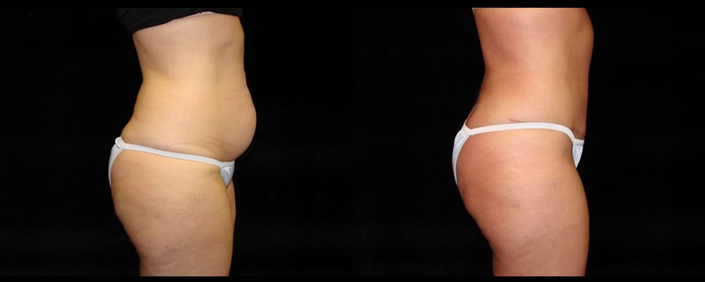 Tummy Tuck Before & After Patient #511
