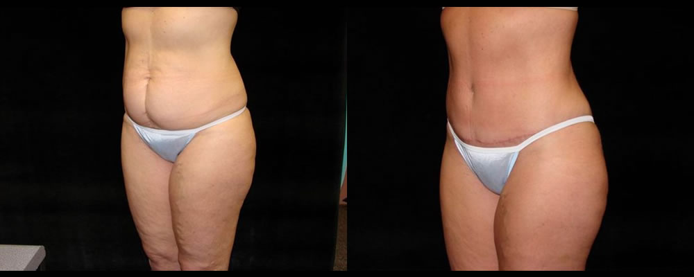 Tummy Tuck Before & After Patient #511