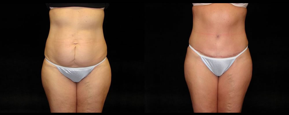 Tummy Tuck Before & After Patient #511