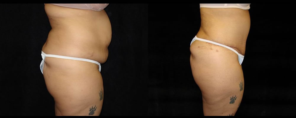 Tummy Tuck Before & After Patient #507