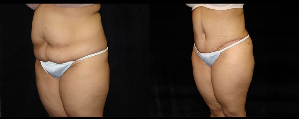 Tummy Tuck Before & After Patient #507