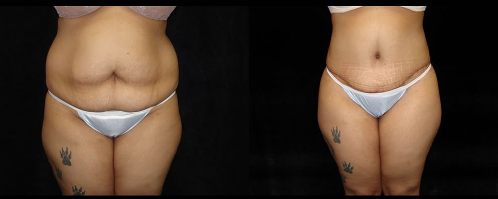 Tummy Tuck Before & After Patient #507