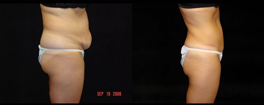 Tummy Tuck Before & After Patient #503