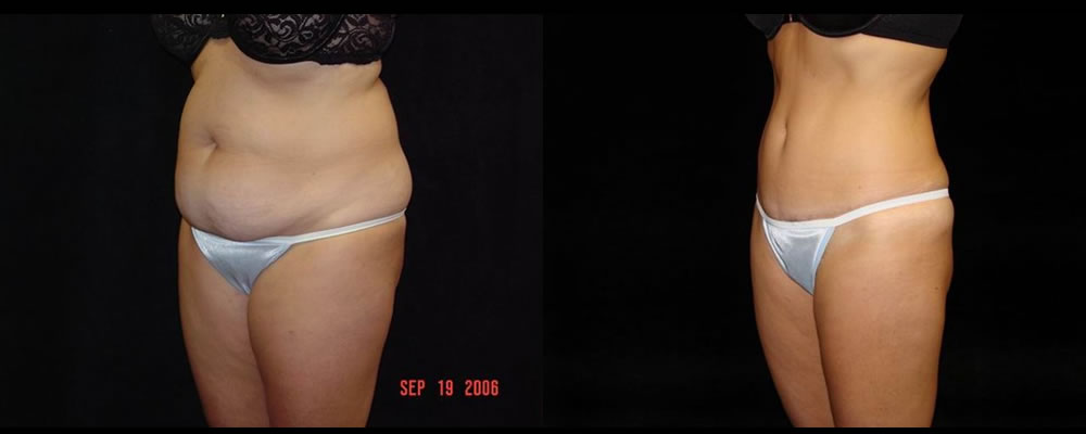 Tummy Tuck Before & After Patient #503