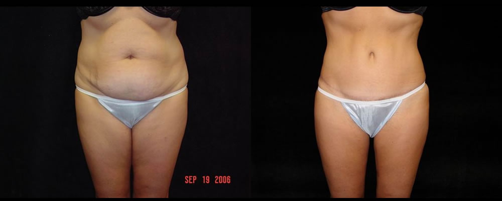 Tummy Tuck Before & After Patient #503