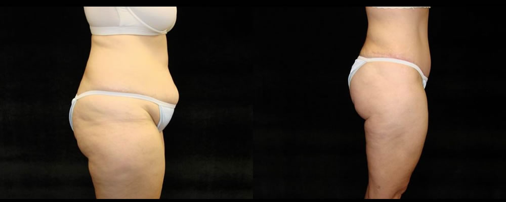 Tummy Tuck Before & After Patient #499