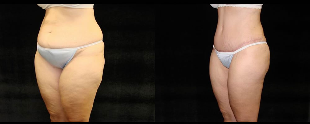 Tummy Tuck Before & After Patient #499