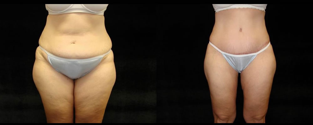 Tummy Tuck Before & After Patient #499