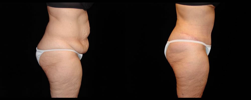 Tummy Tuck Before & After Patient #600