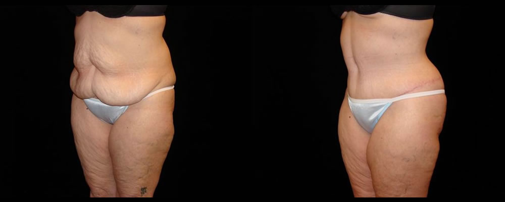 Tummy Tuck Before & After Patient #600