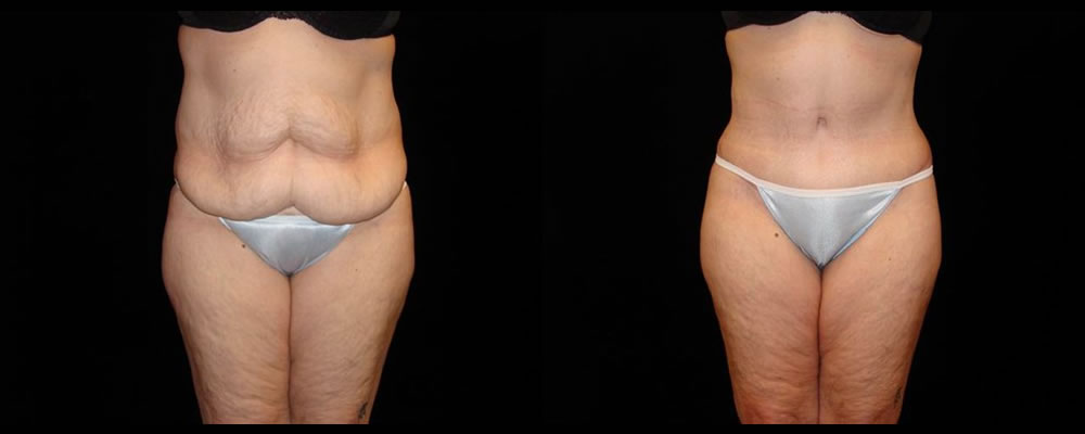 Tummy Tuck Before & After Patient #600