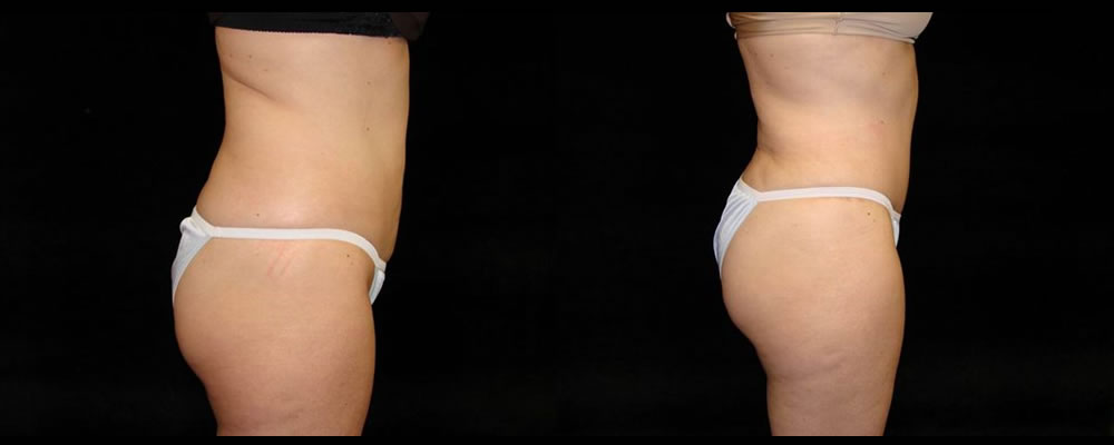 Tummy Tuck Before & After Patient #495