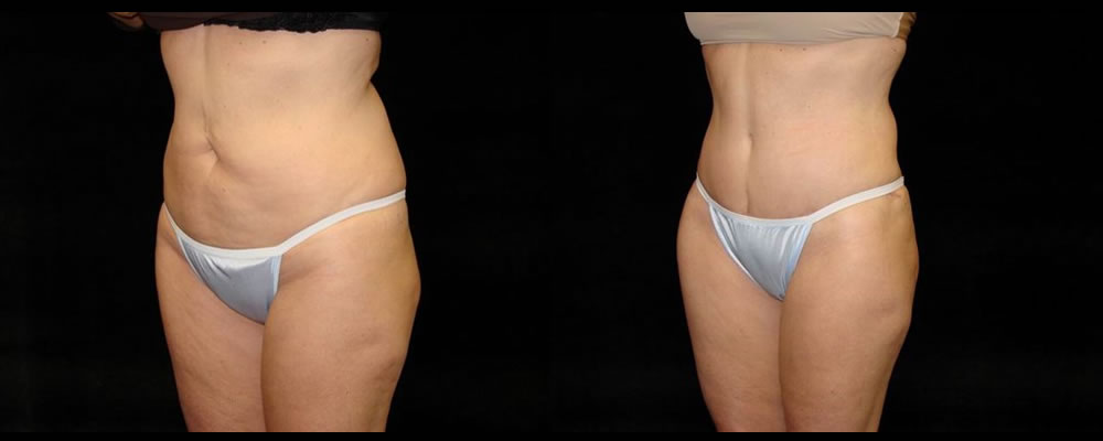 Tummy Tuck Before & After Patient #495