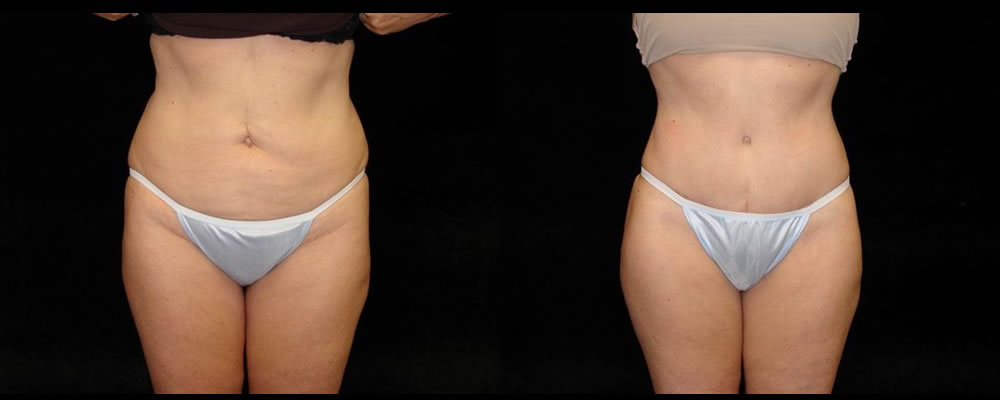 Tummy Tuck Before & After Patient #495