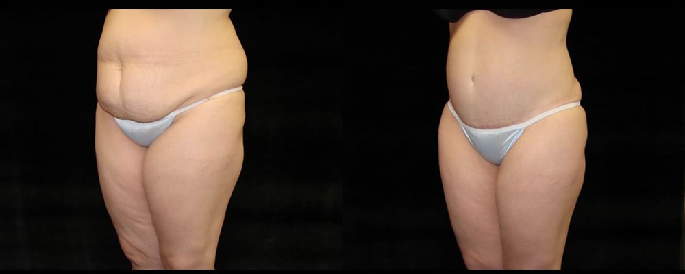 Tummy Tuck Before & After Patient #491