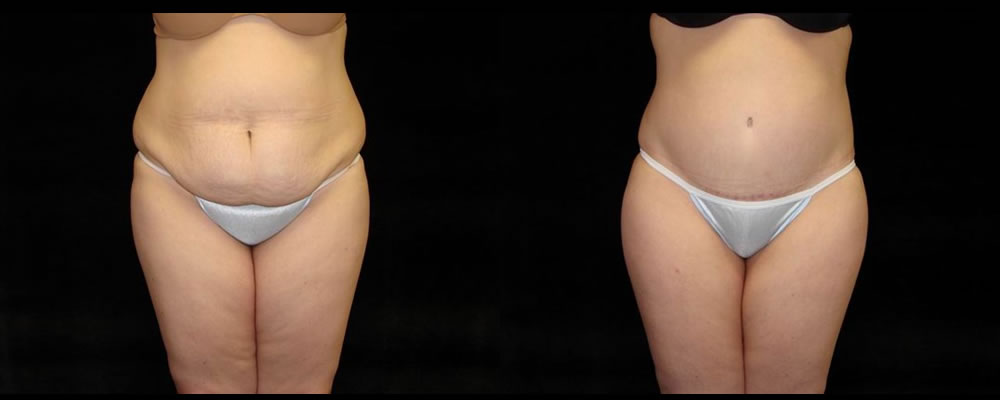 Tummy Tuck Before & After Patient #491