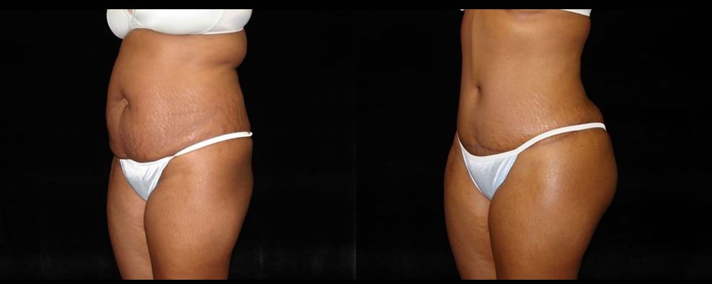 Tummy Tuck Before & After Patient #487