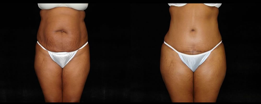 Tummy Tuck Before & After Patient #487