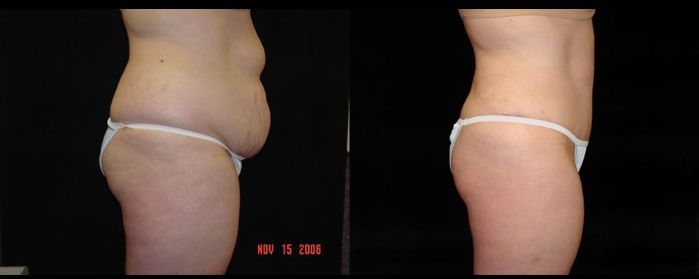 Tummy Tuck Before & After Patient #483