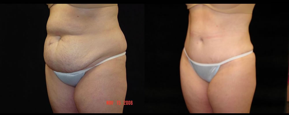 Tummy Tuck Before & After Patient #483