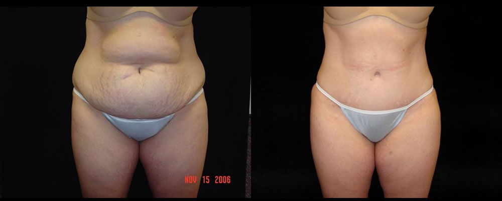 Tummy Tuck Before & After Patient #483