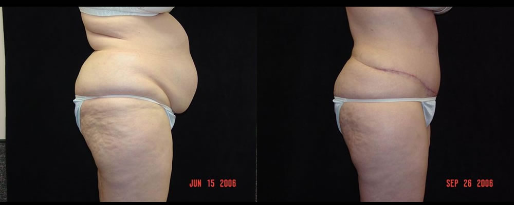 Tummy Tuck Before & After Patient #479