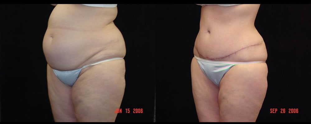 Tummy Tuck Before & After Patient #479