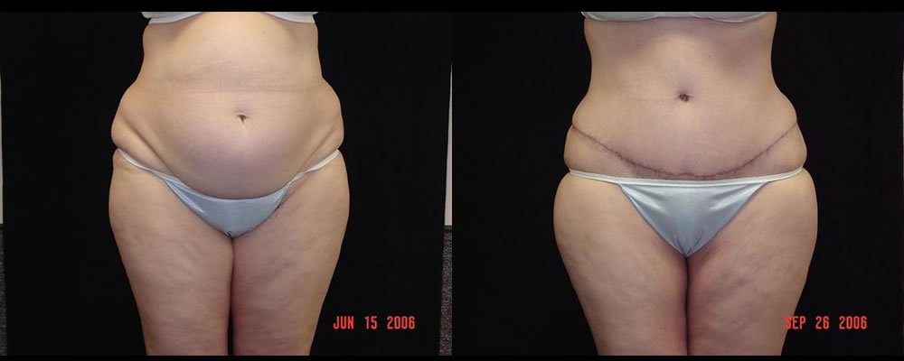 Tummy Tuck Before & After Patient #479