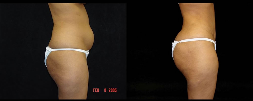 Tummy Tuck Before & After Patient #475