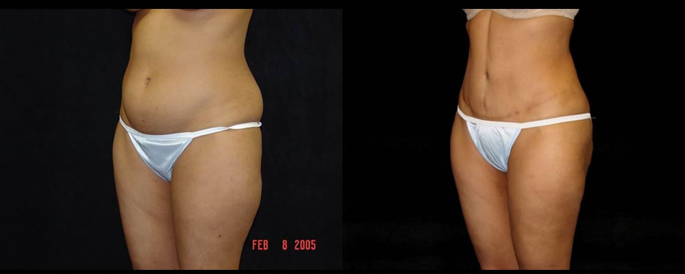 Tummy Tuck Before & After Patient #475