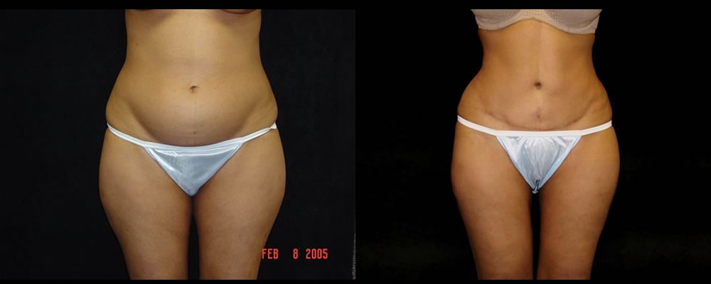 Tummy Tuck Before & After Patient #475