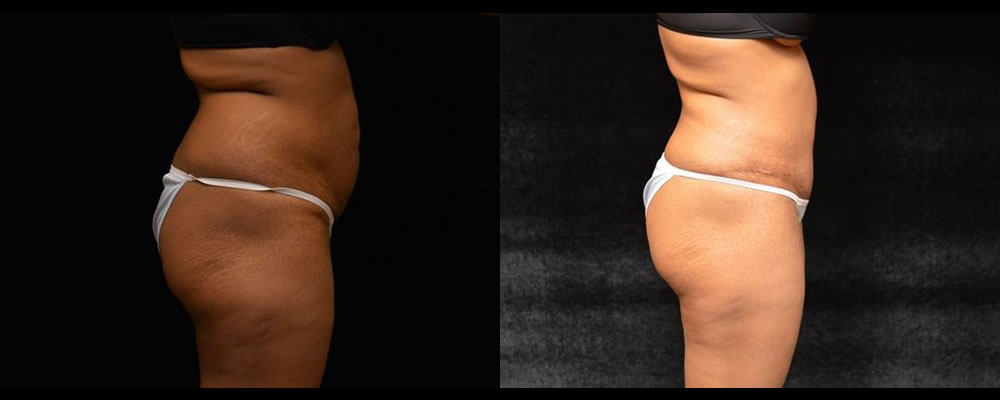 Tummy Tuck Before & After Patient #471
