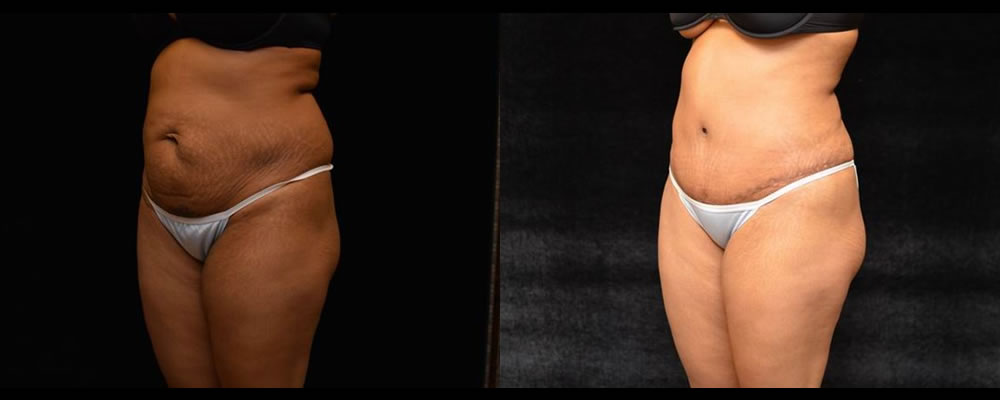 Tummy Tuck Before & After Patient #471