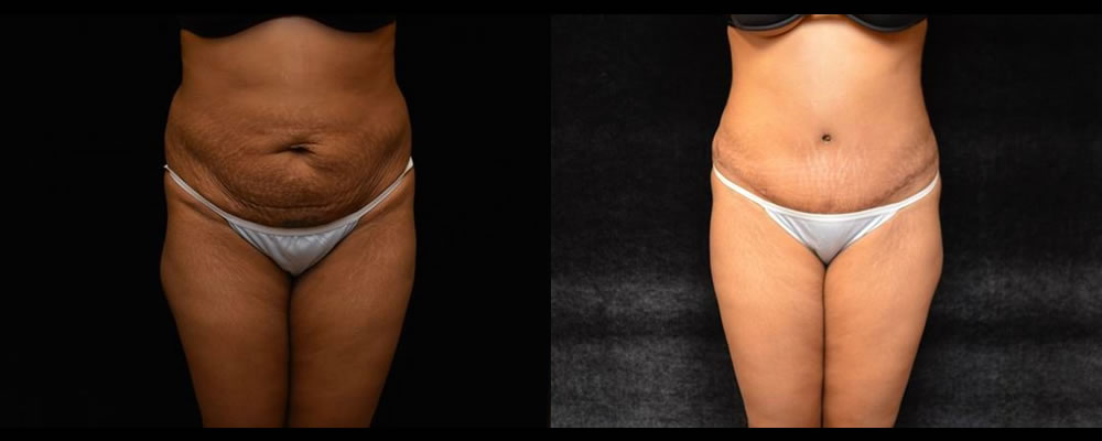 Tummy Tuck Before & After Patient #471