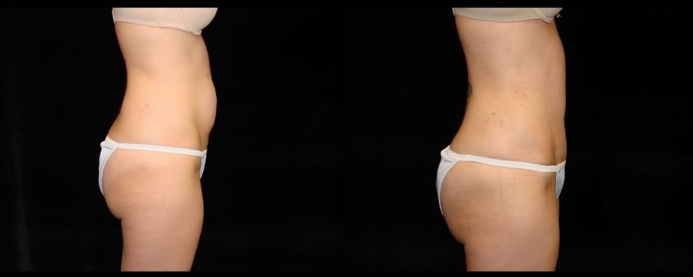 Tummy Tuck Before & After Patient #467