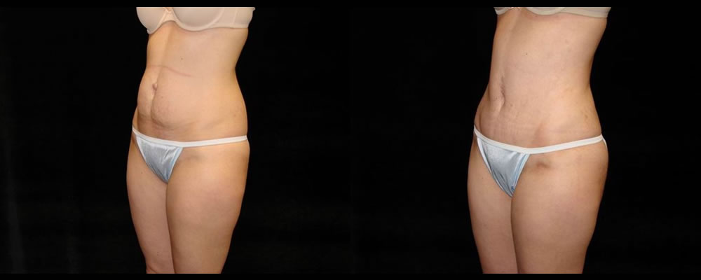 Tummy Tuck Before & After Patient #467