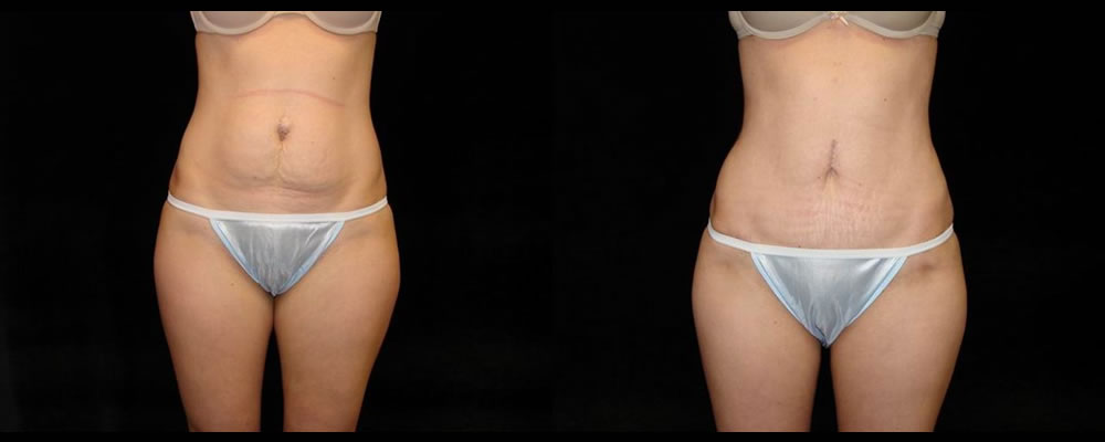 Tummy Tuck Before & After Patient #467