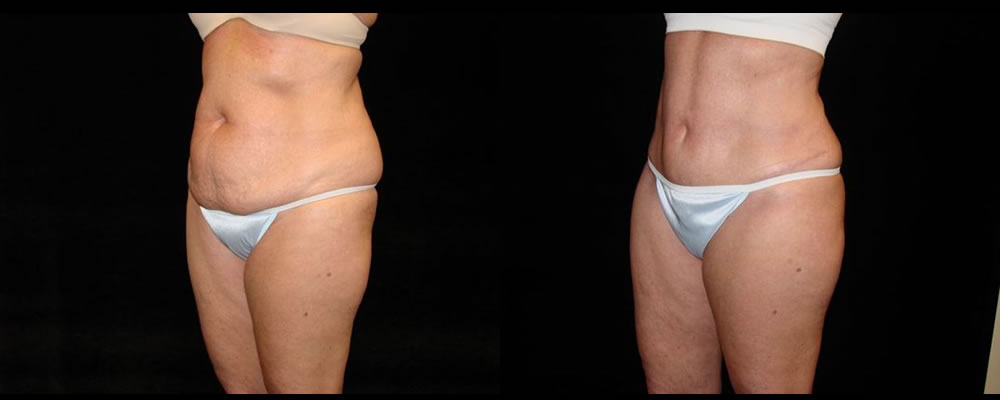 Tummy Tuck Before & After Patient #463