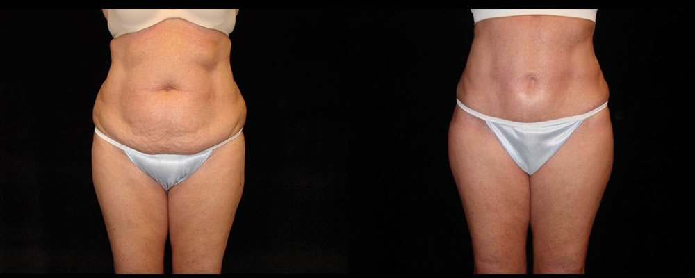 Tummy Tuck Before & After Patient #463