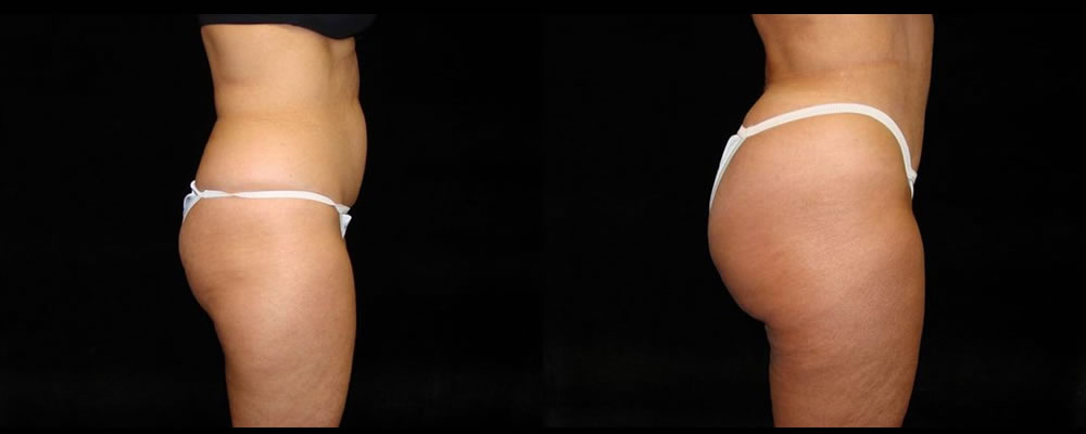 Tummy Tuck Before & After Patient #459