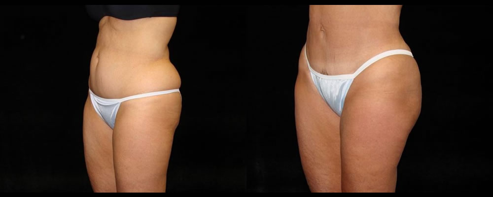 Tummy Tuck Before & After Patient #459