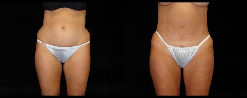 Tummy Tuck Before & After Patient #459