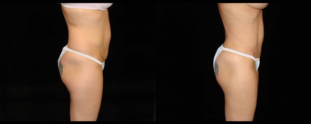 Tummy Tuck Before & After Patient #596